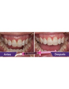 Opalustre Ultradent 2
